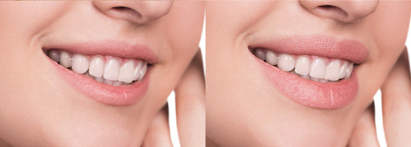 Lippen vergrößern - Vorher / Nachher