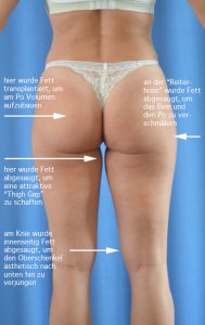 Fettabsaugung am Oberschenkel und Knie